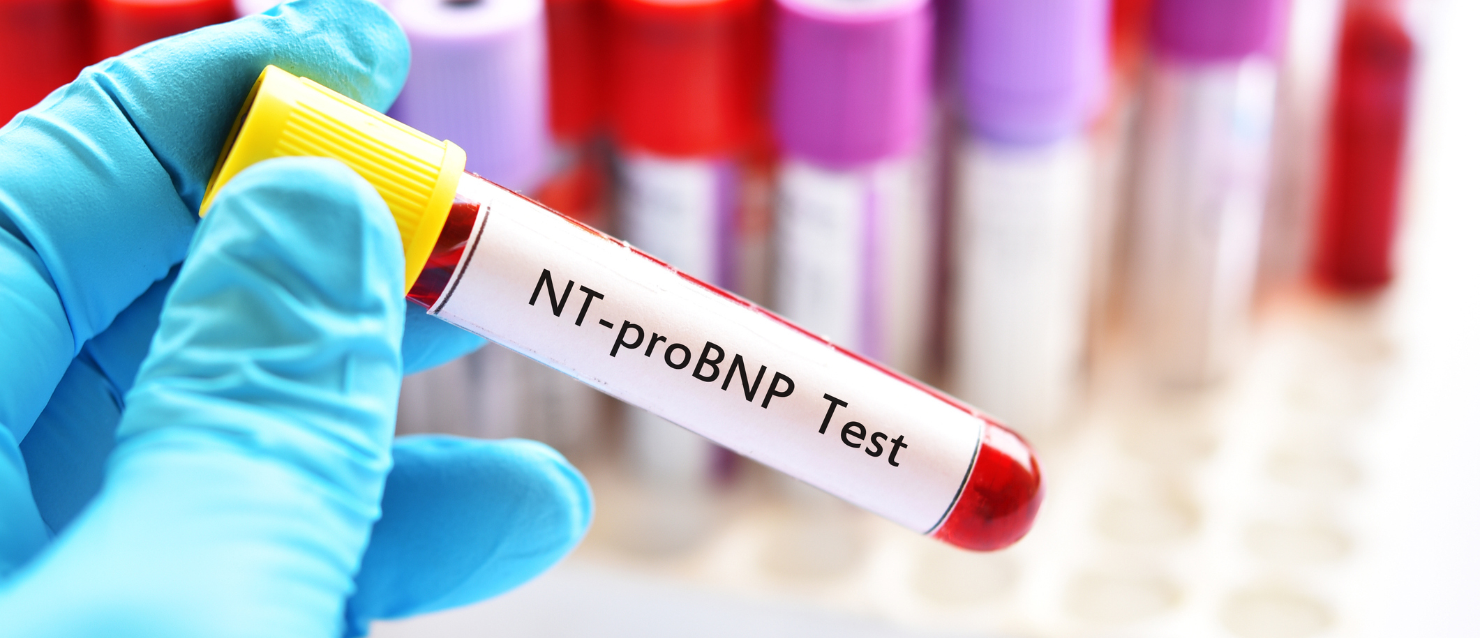 NT-proBNP test